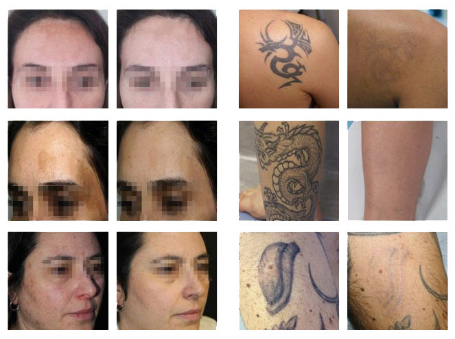 Eyebrow Tattoo Removal: What to Expect and How to Prepare